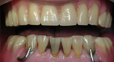 Dental Implants in Erie, PA - Kneib Dentistry PC