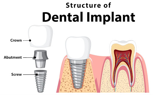 dental implant diagram kneib dentistry