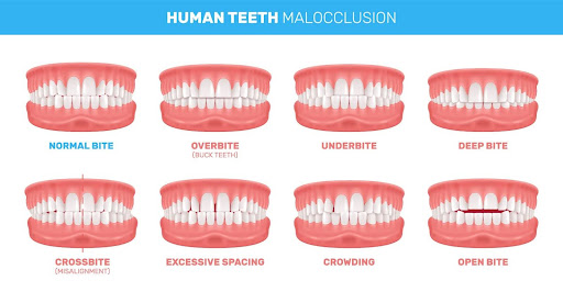 bite alignements kneib dentistry